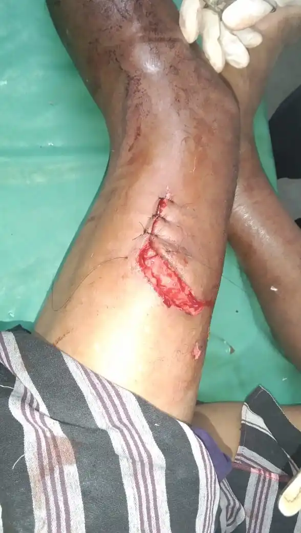 भालू के हमले से ग्रामीण घायल